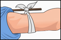 Arm with cloth tied with knot below and on top of stick