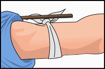Parte alta del brazo con un trozo de tela atado y un palo encima del nudo