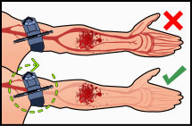 Un brazo con un torniquete no suficientemente apretado y la sangre en las venas yendo a la mano. Segundo brazo con un torniquete apretado y con la sangre de las venas parando donde el torniquete.